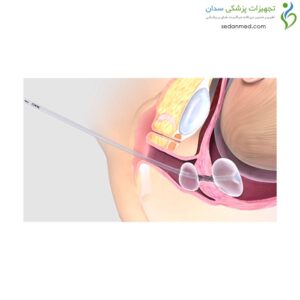 بالن رایپنینگ کوک مدیکال (Cook medical)