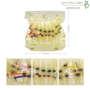 مولاژ دندان مدل ارتودنسی و درمان مالوکلوژن با براکت و کش‌های لیگاتور