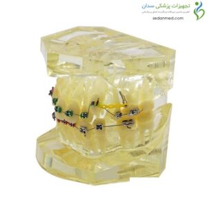 مولاژ دندان مدل ارتودنسی و درمان مالوکلوژن با براکت و کش‌های لیگاتور