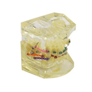 مولاژ دندان مدل ارتودنسی و درمان مالوکلوژن با براکت و کش‌های لیگاتور