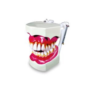 مولاژ دندان نمایش تورم لثه