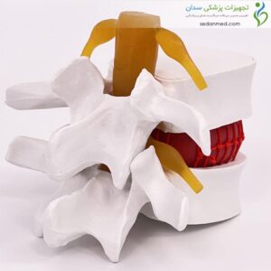 مولاژ دیسک کمر