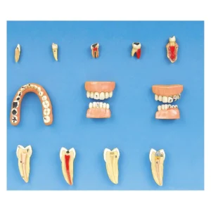 مولاژ مدل بیماری و امراض دندان